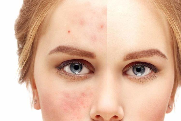Pourquoi l'acné apparaît sur le visage
