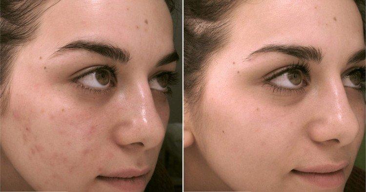 Peeling du visage - photos avant et après