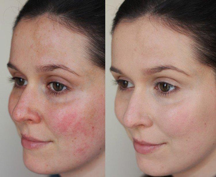 Peeling du visage - photos avant et après