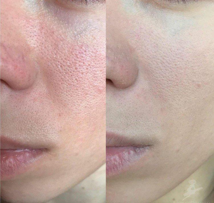 Peeling du visage - photos avant et après