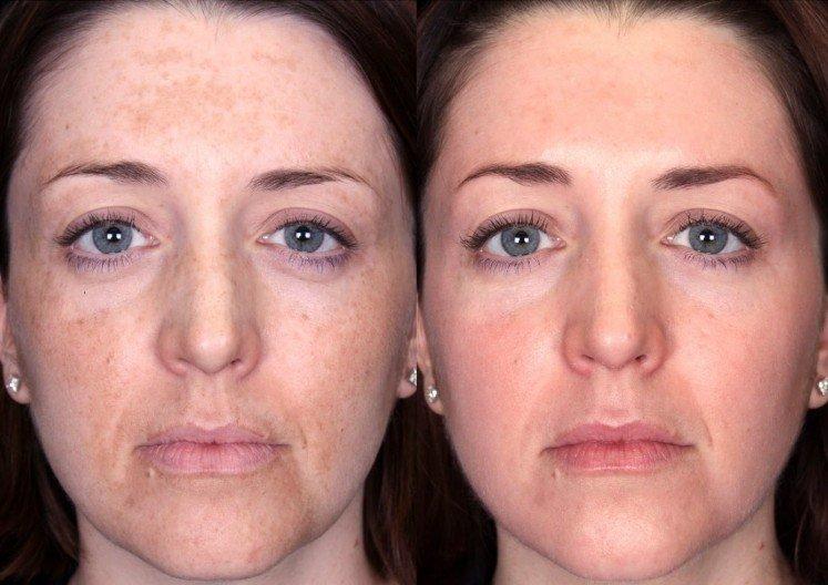 A quoi ça sert - Peeling du visage à la maison