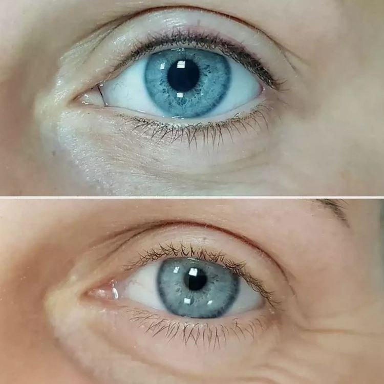 Tatouage des yeux - photos avant et après