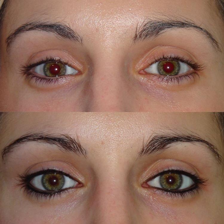 Tatouage des yeux - photos avant et après