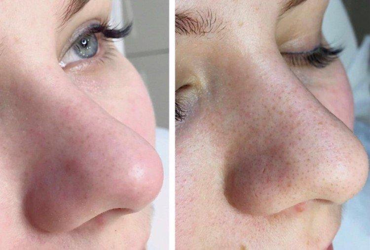 Nettoyage du visage par ultrasons - photos avant et après