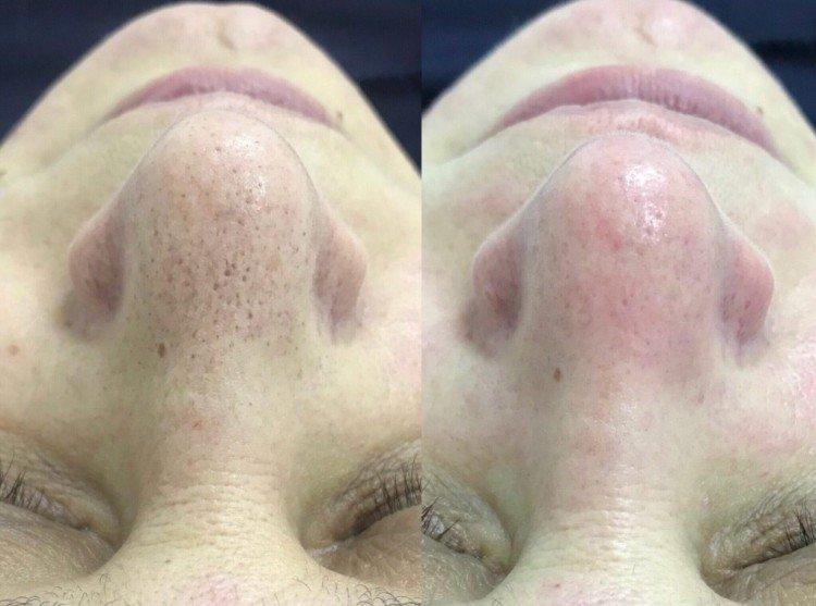 Nettoyage du visage par ultrasons - photos avant et après